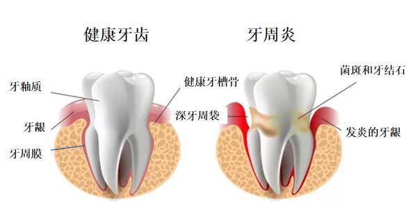 牙齿|刷牙出血？因为口腔太脏！来听牙菌斑的悄悄话~
