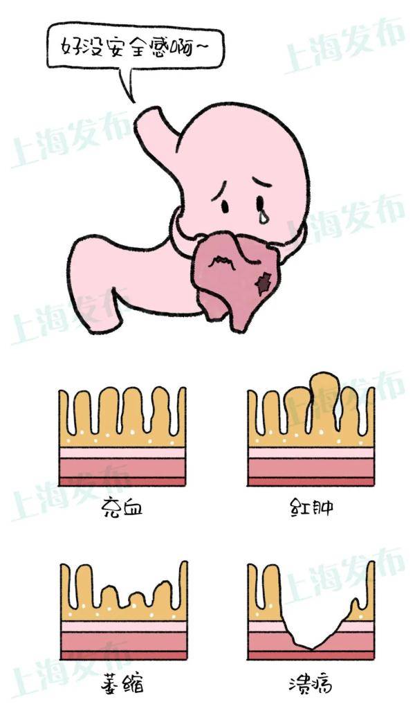 细胞|【医聊】从胃炎到胃癌，胃粘膜扛下了所有~