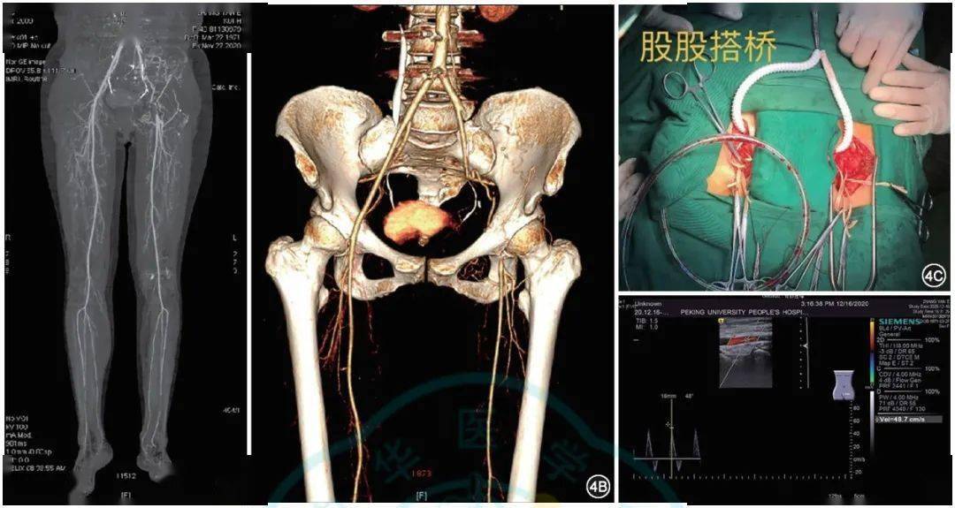 趙誌慶骨盆骶骨腫瘤切除術中應用腹主動脈球囊的股動脈穿刺相關併發症