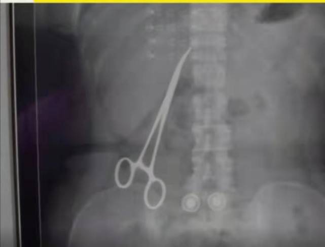 女子|止血钳遗留在女子腹中超15个月：院方否认，已被取出等鉴定