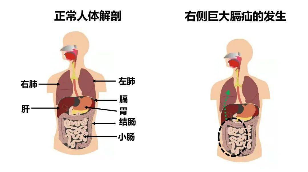 运动|男子健身用力过猛，肠子移位挤满右胸腔，健身一定要注意...