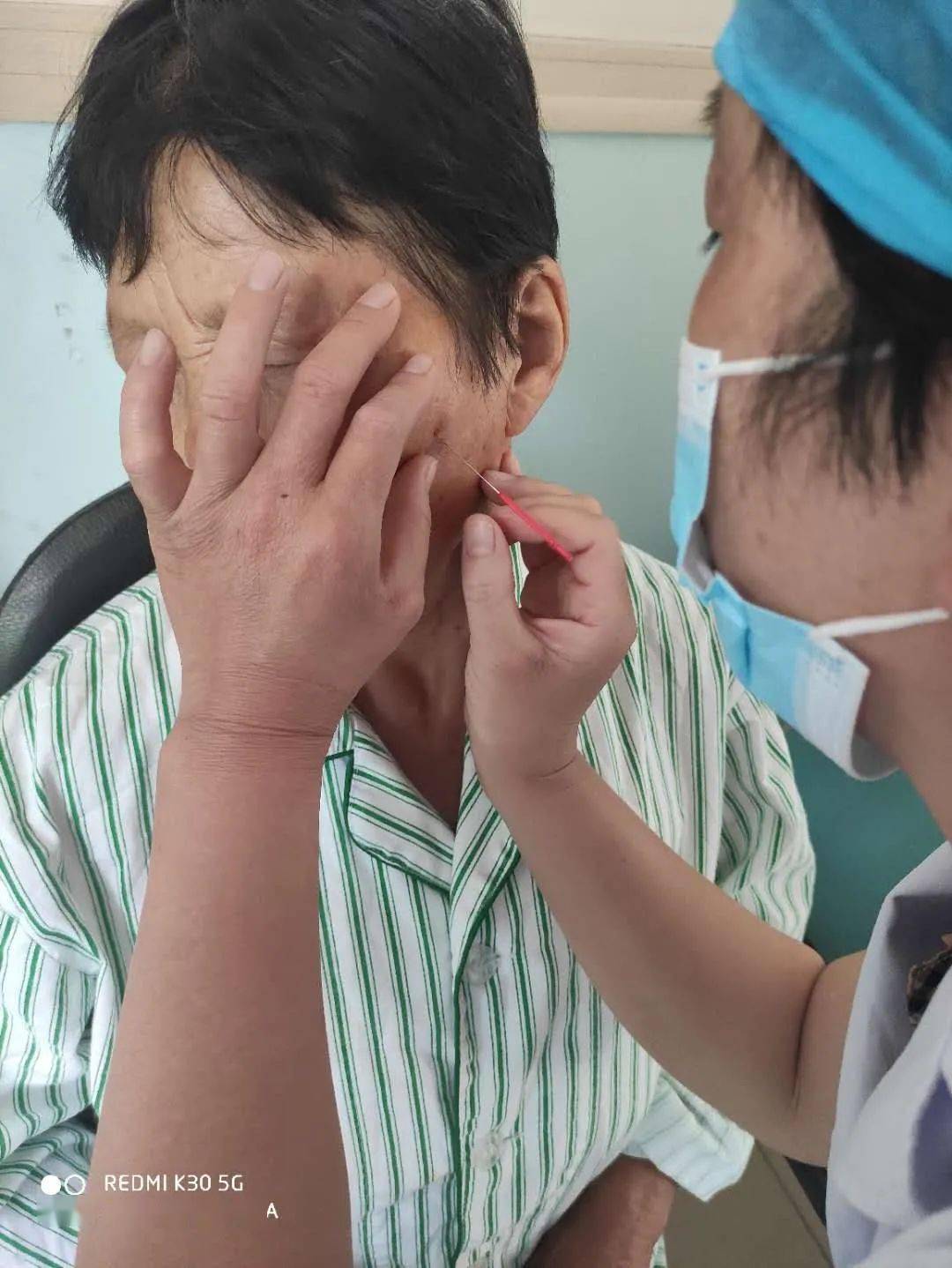 二院耳鼻喉科告别难受体验鼻炎治疗第一针蝶腭神经节针刺术