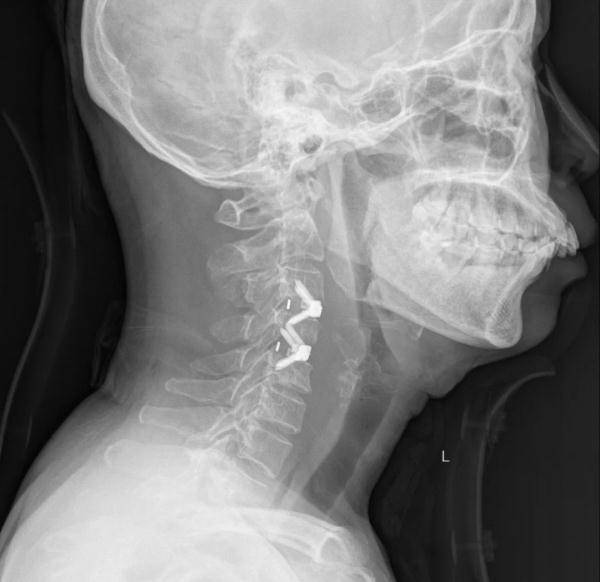 风险|两节颈椎被“吃掉”，五旬阿姨险瘫痪！