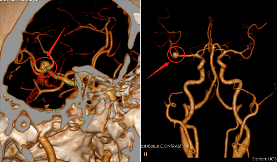 中动脉m1段分叉处动脉瘤,宽颈,张力高,其后发出2支额干,2支颞干血管