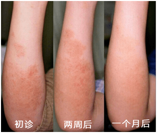 一二九街|痒！痒！痒！每天都挠到流血……