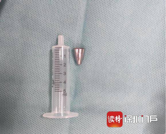 笔帽|惊险！10岁男孩跌倒，把笔帽吞了下去…