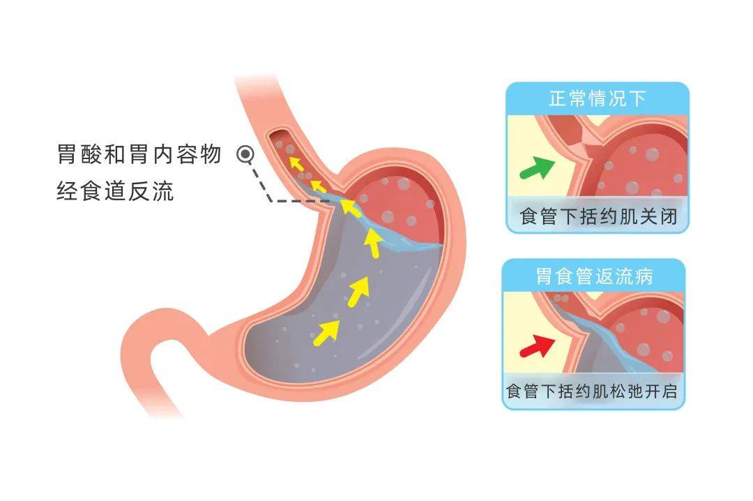 反覆咳嗽,氣喘,聲嘶,元兇竟是胃食管反流病!_症狀