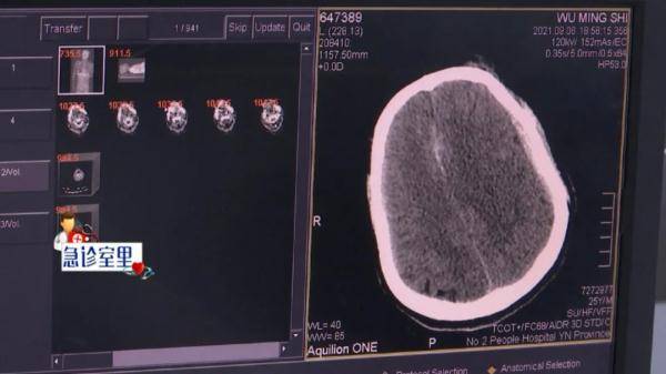 男子|骑共享单车发生事故，男子脑出血生命垂危，开颅手术成了唯一希望……