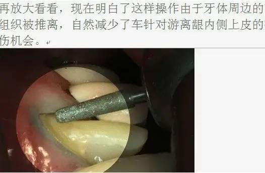 口腔临床排龈线基础