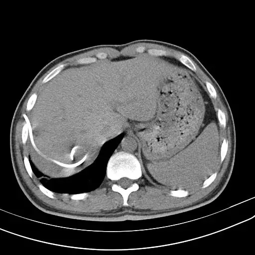 什么|教你从肺CT上分辨是哪种细菌感染丨肺炎克雷伯杆菌篇