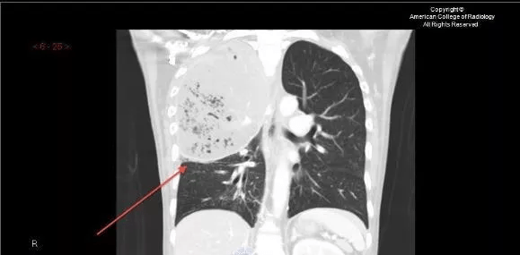 什么|教你从肺CT上分辨是哪种细菌感染丨肺炎克雷伯杆菌篇