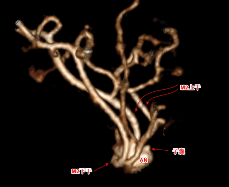 二医|高致死性脑动脉瘤破裂出血，3小时精准手术成功拆“炸弹”