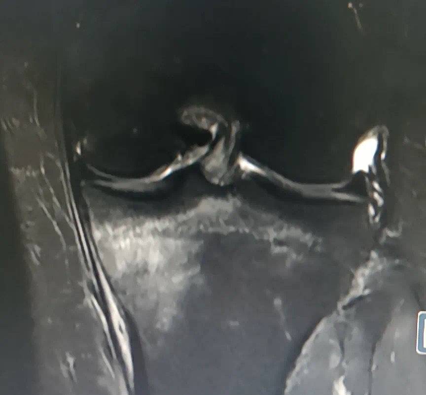 女子|每天跳绳1000个，成都30岁女子跳骨折了！骨科医生给你提建议！