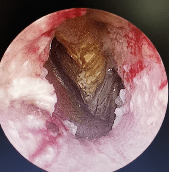 蟑螂|半夜耳朵痛醒，一查吓一跳！千万不要这样做