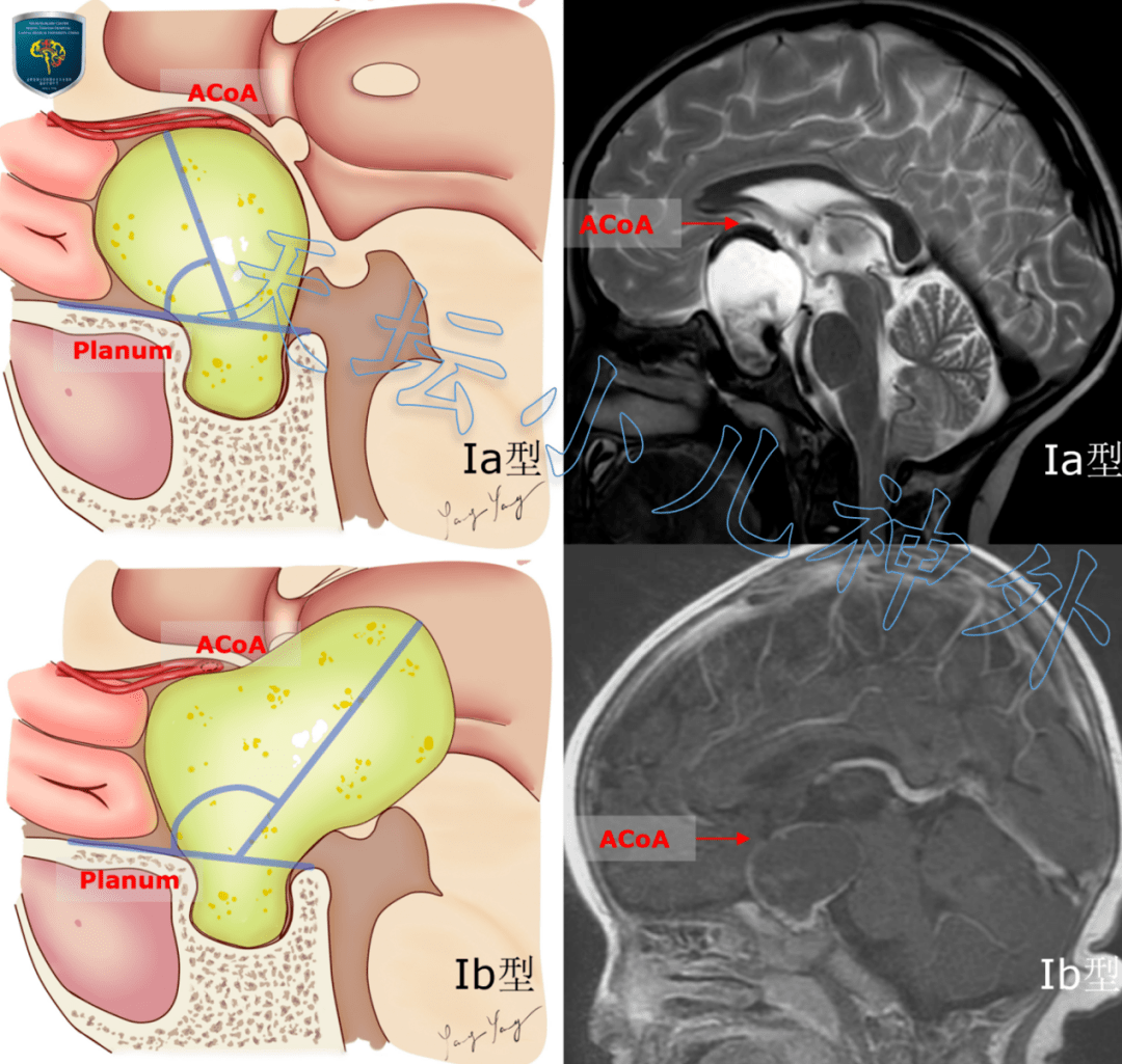 天坛小儿神外宫剑教授访谈儿童颅咽管瘤经前纵裂入路手术难度分型及