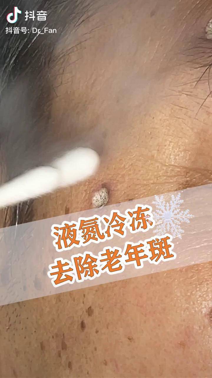 液氮冷冻去除老年斑,2周后对比,一起体验下!