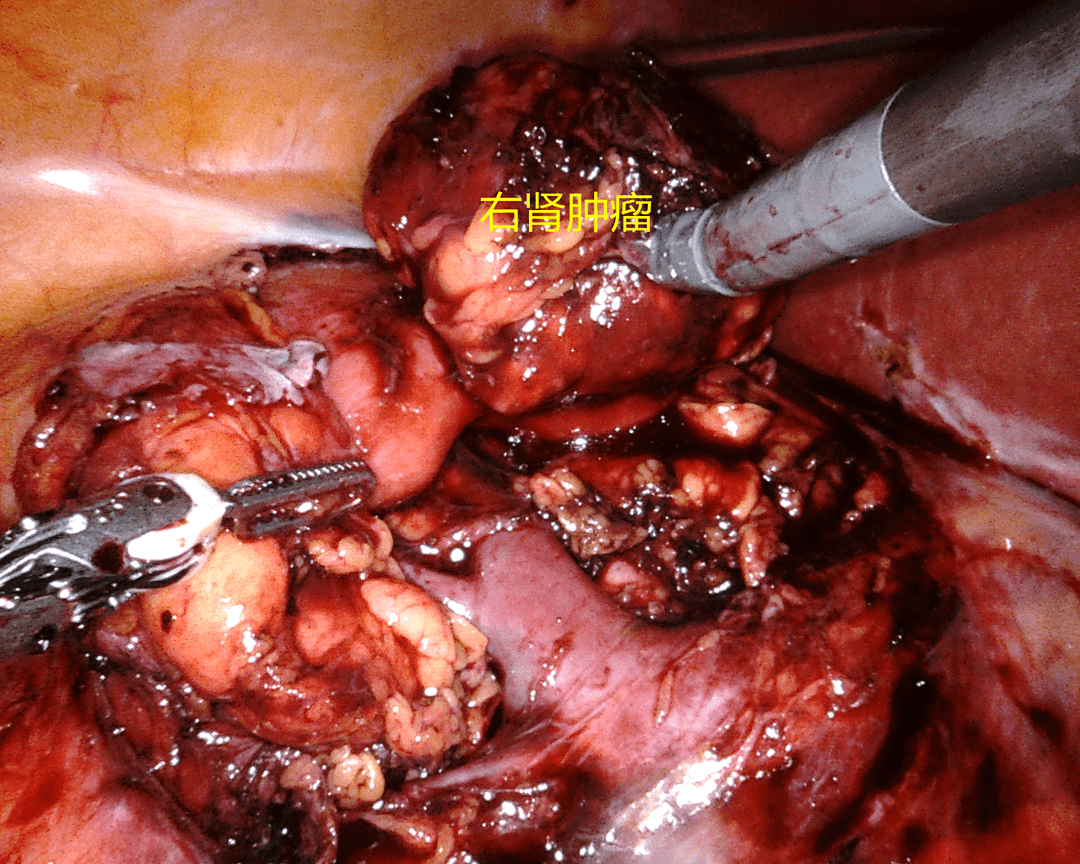 手术分别为一例右侧肾门处5cm肾错构瘤行机器人辅助下腹腔镜右肾部分