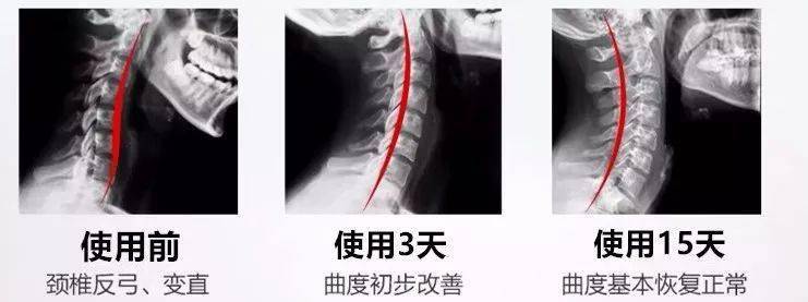 颈椎|头晕恶心手麻原来是颈椎出了毛病！睡它，30分钟缓解酸痛，1个月连血压都降了