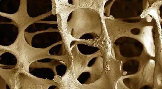 喝一次等于喝3斤白酒骨科医生常喝让你骨头变成马蜂窝