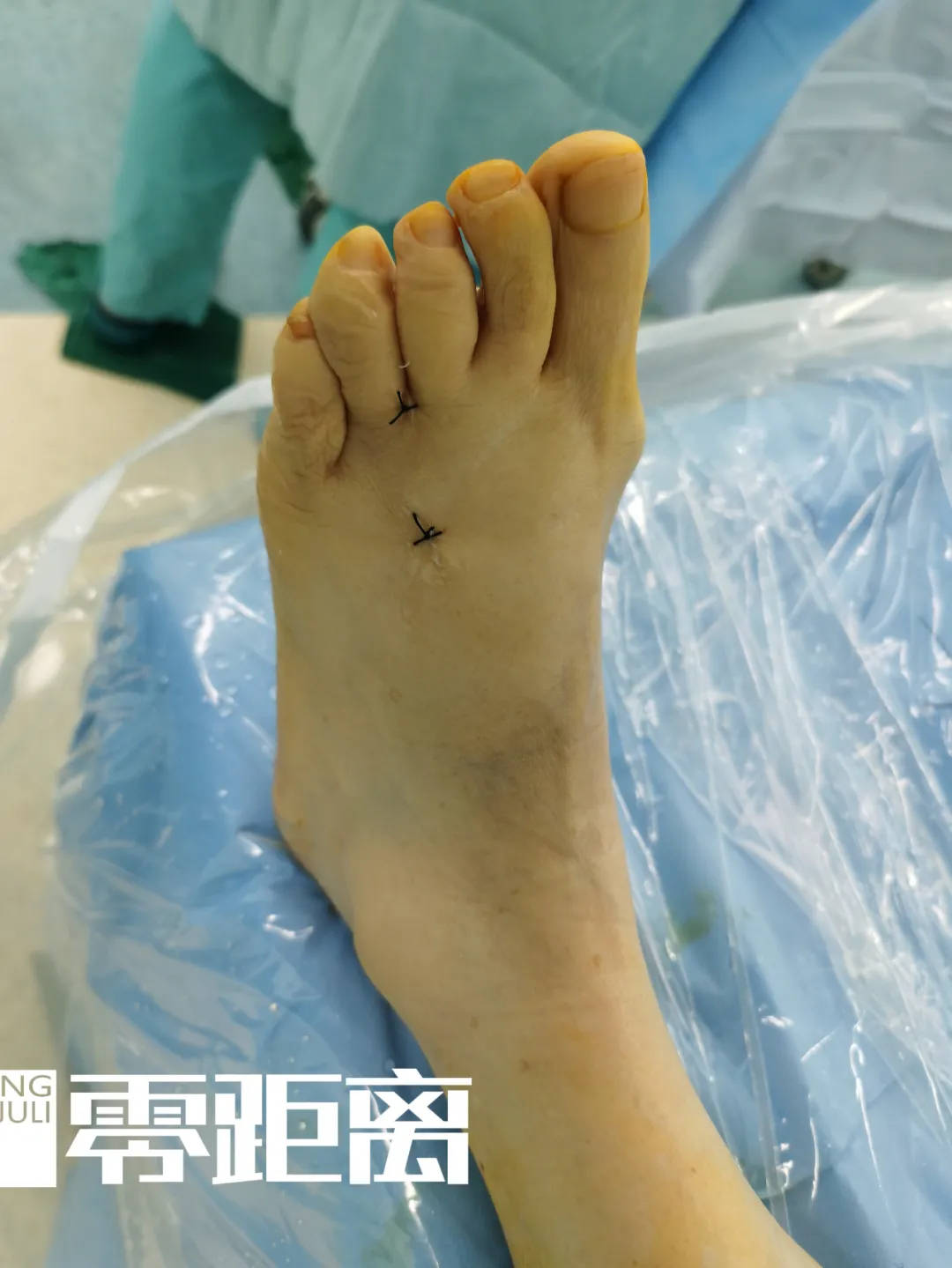 女子脚趾长肿瘤竟是穿鞋不当引发医生这种疾病好发于女性