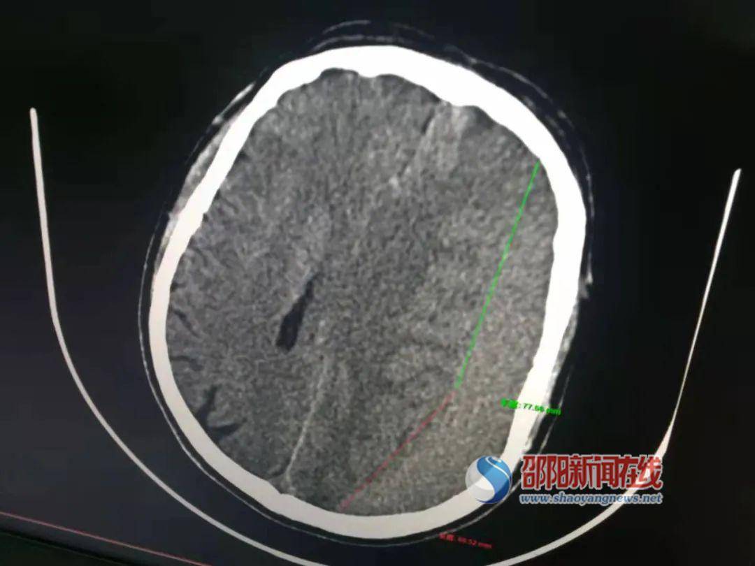 时间|邵东市中医医院：硬通道钻孔引流术治疗创伤性硬脑膜下血肿及慢性硬膜下血肿取得成功