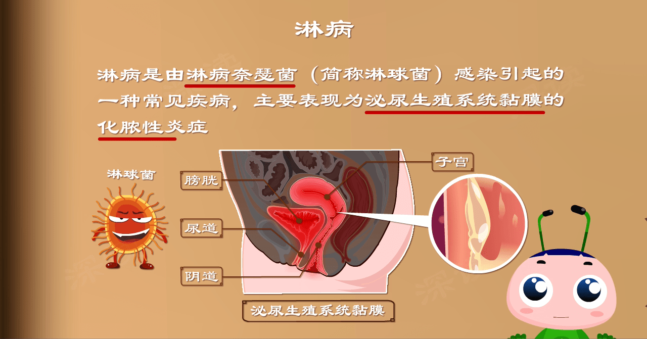 淋病女性下面图片