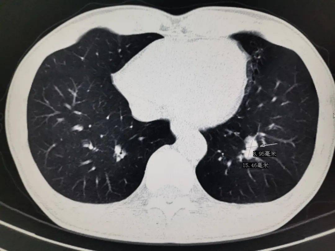 第一次胸部ct扫描