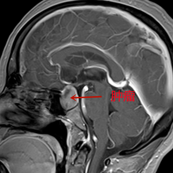 垂体瘤图片头部图片