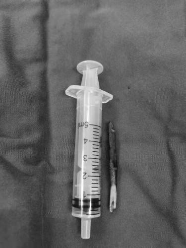 识别|黄豆秆插入小儿膝盖发生“位移” 专家精准找到成功取出