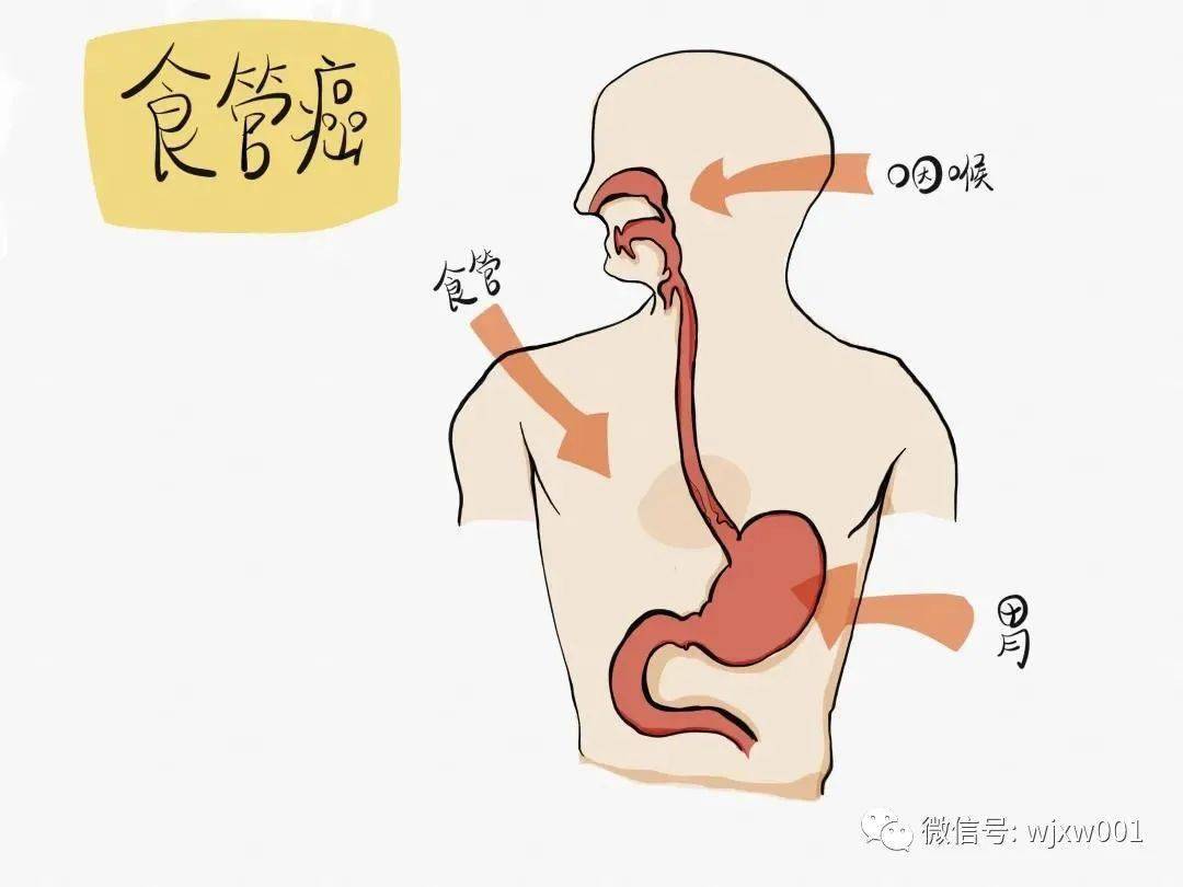 小心食道癌惠州有人因愛喝熱茶喝進了醫院