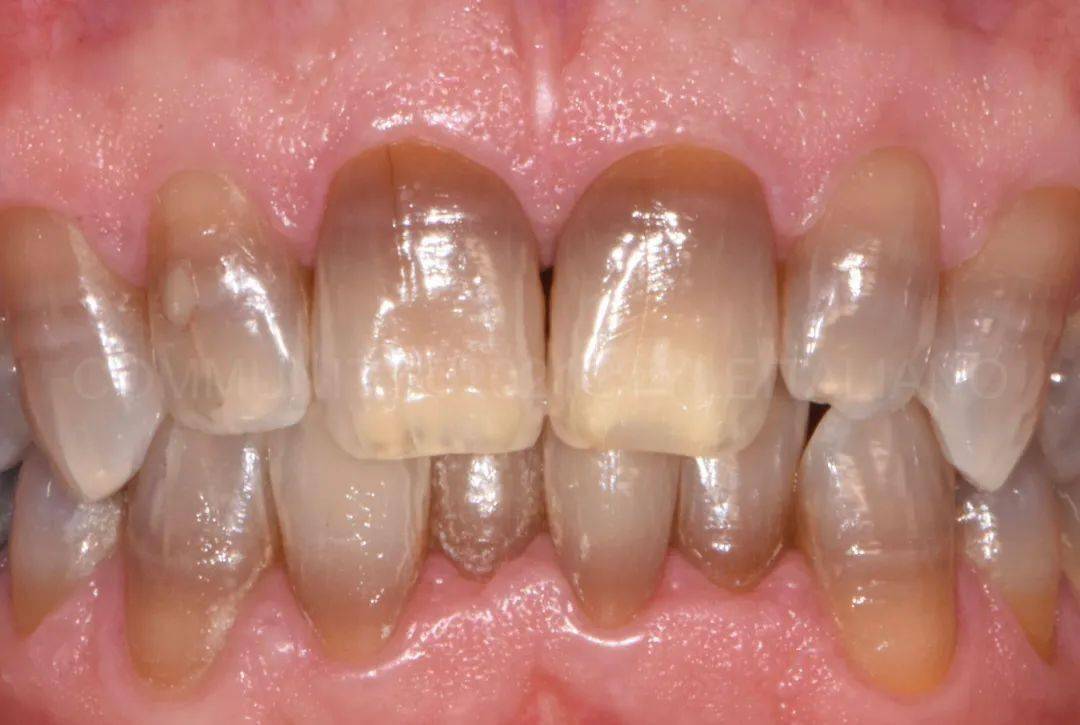 【牙医学堂】无法漂白的重度四环素牙漂白治疗
