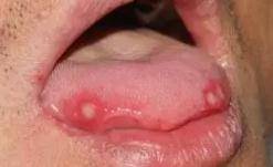 感觉|以为是口腔溃疡，却被诊断为口腔癌？