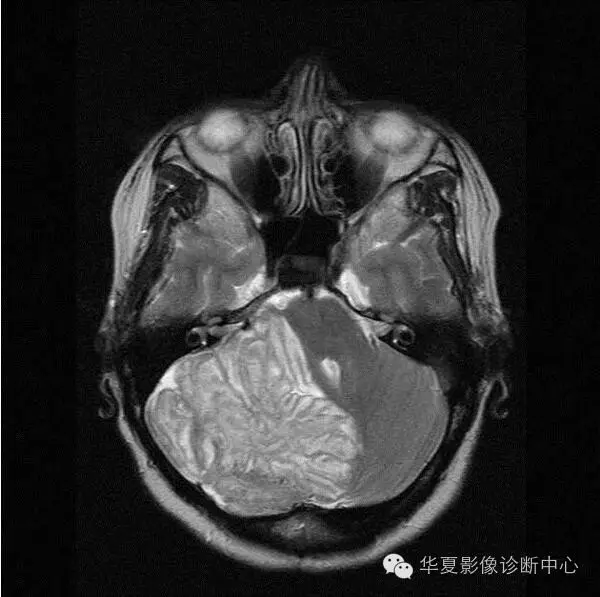 畸形|這 6 種典型影像征象的病變你都認識了嗎
