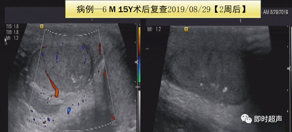 陰囊超聲應用解剖及相關急症的超聲診斷