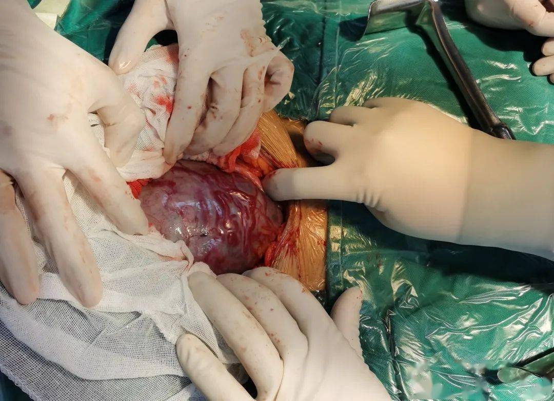 全力以赴救治凶险性前置胎盘胎盘植入产妇