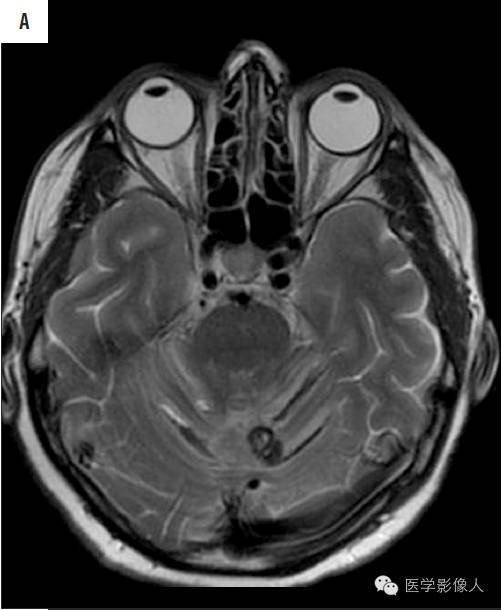 黄素环|脑内T2WI上低信号病变大致分为8大类【总结】