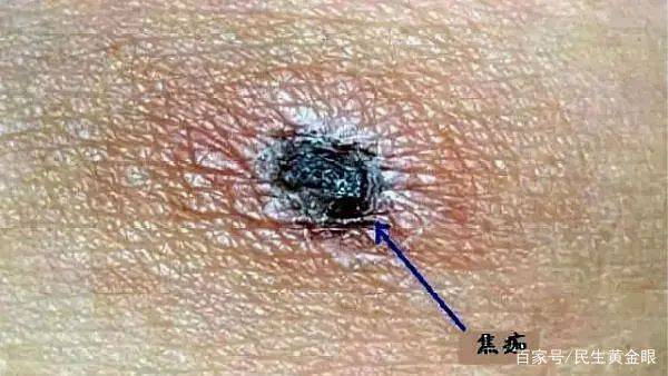 半月|男子持续半月高热不退，因被这种小虫子叮咬，外出游玩务必当心…