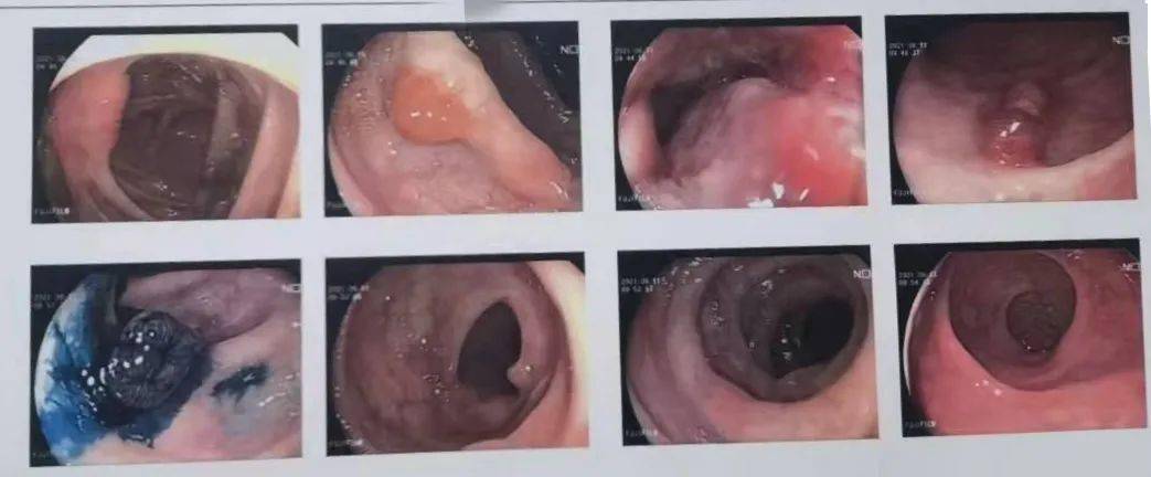 罕见59岁老汉和表弟双双查出肠癌医生建议儿子尽快检查