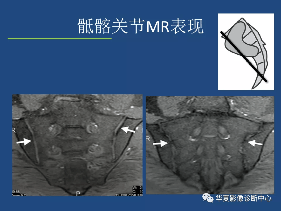 强直性脊柱炎影像诊断和鉴别诊断