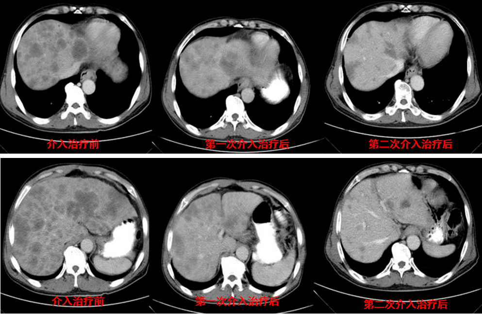 一例her2晚期胃癌肝转移病例的介入联合靶向治疗过程丨抗her之路 与妮