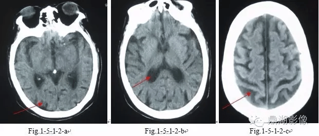 Fig|脑萎缩与硬膜下积液的鉴别
