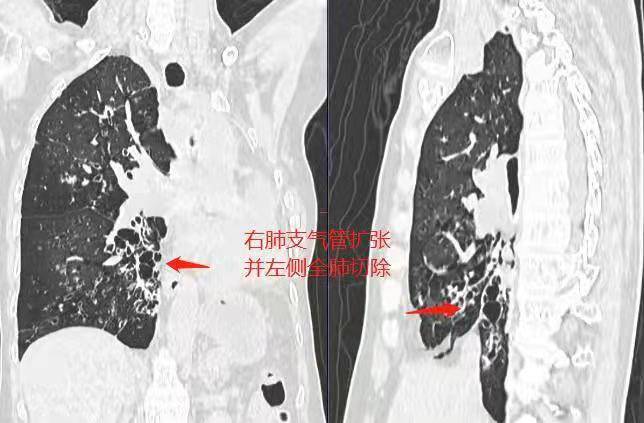 广州|肿瘤涨大八倍却难手术，广州医生为肺功能不足患者成功摘瘤