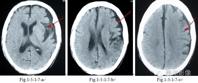 Fig|脑萎缩与硬膜下积液的鉴别