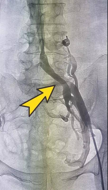 静脉|益阳市中心医院：不一样的“腿肿”，原是“髂压”惹的祸