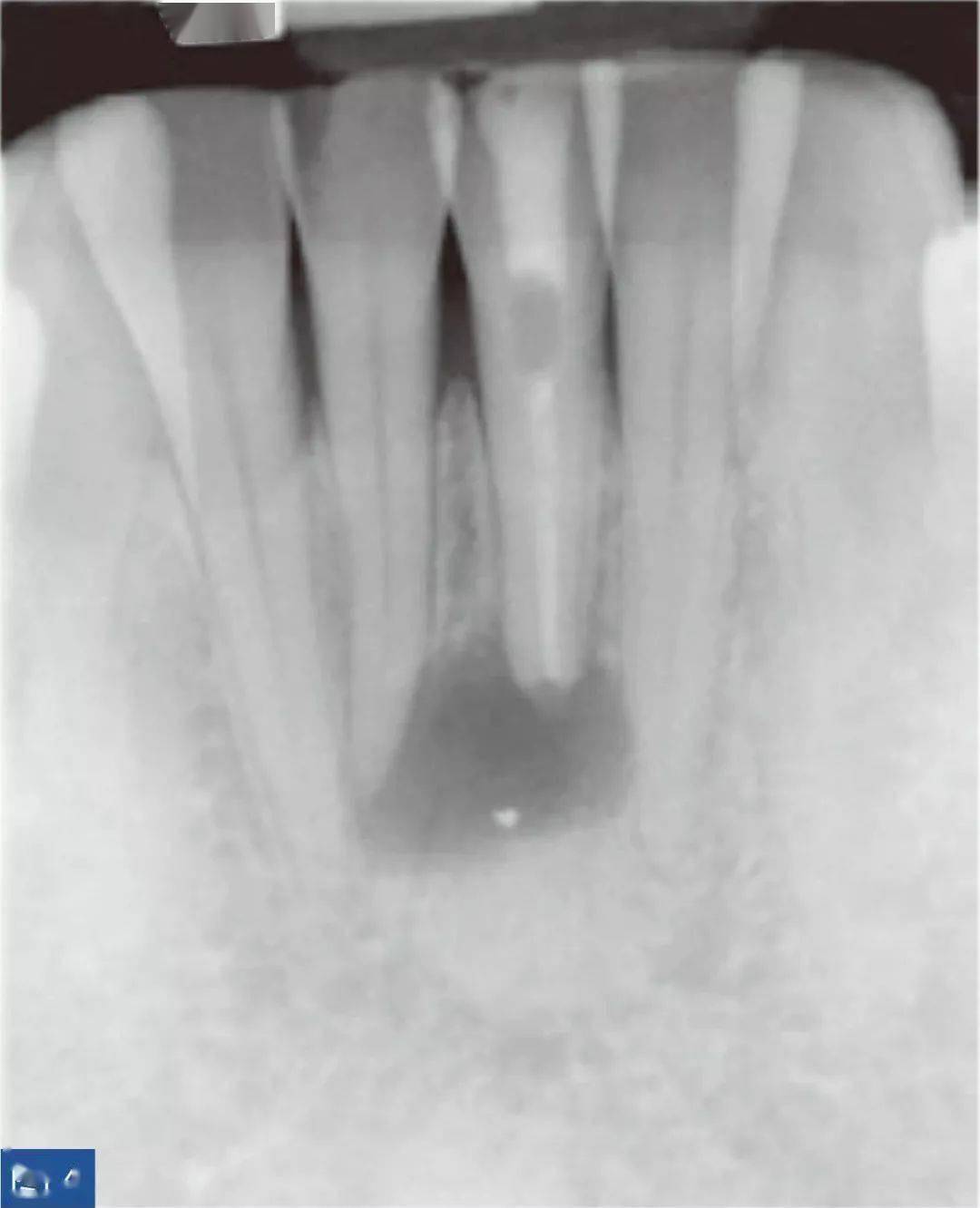 求老师们指点，这个乳牙根尖周炎病例怎么解决比较好-陈广益的博客-KQ88口腔博客
