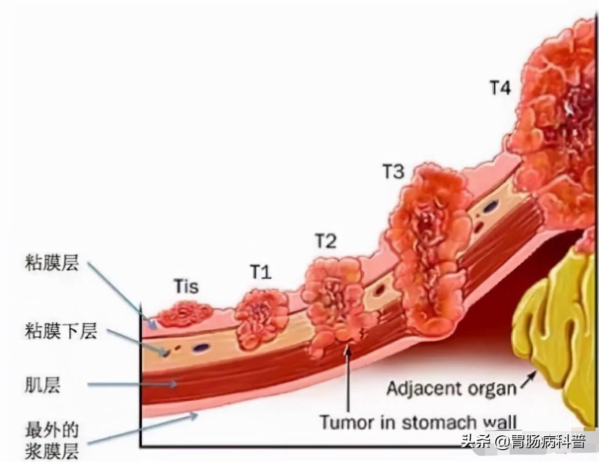 在不同阶段,胃癌患者5年内的生存率分别为:如果有淋巴,脏器转移,能活