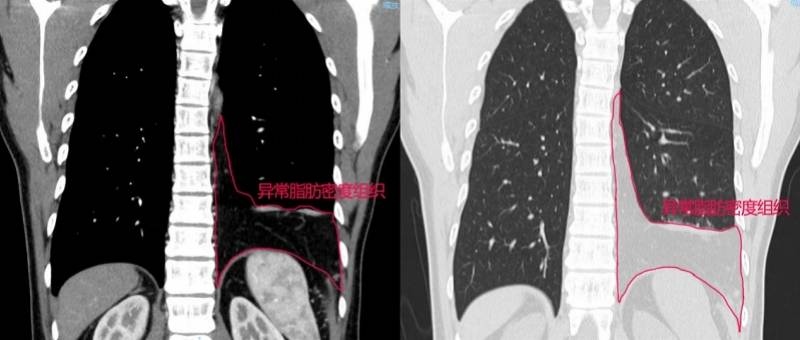网膜|腹部脂肪“漏”进胸腔里，28岁小伙胸闷原因竟是巨大膈疝