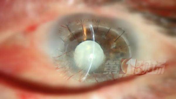 视网膜|深圳一女生摸黑玩手机瞳孔变白，罪魁祸首竟是...