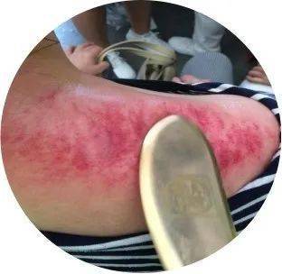 老年病科中医适宜技术虎符铜砭刮痧