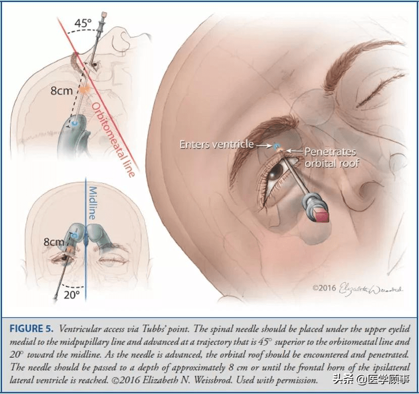 operative neurosurgery:颅骨测量与脑室穿刺